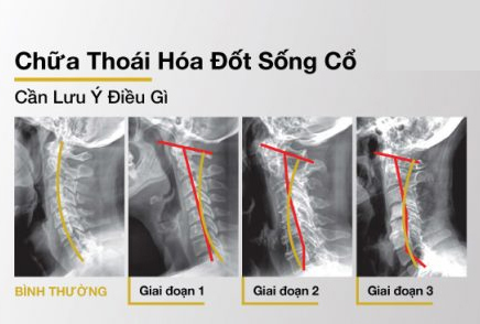 PHƯƠNG PHÁP CHỮA THOÁI HÓA CỘT SỐNG CỔ KHỎI LÂU DÀI