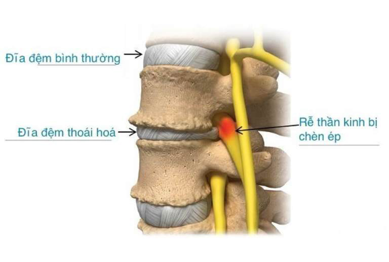 CÁCH ĐIỀU TRỊ BỆNH THOÁI HÓA ĐĨA ĐỆM AN TOÀN VÀ HIỆU QUẢ