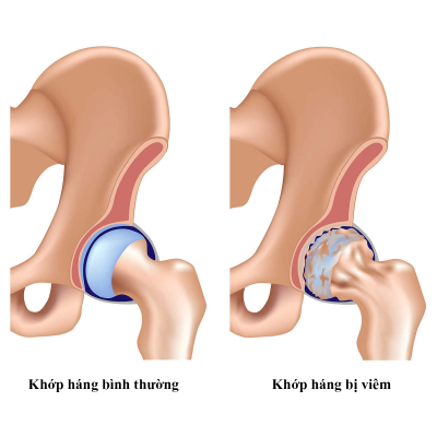 THOÁT HÓA KHỚP HÁNG, VIÊM KHỚP HÁNG - NGUYÊN NHÂN VÀ CÁCH ĐIỀU TRỊ